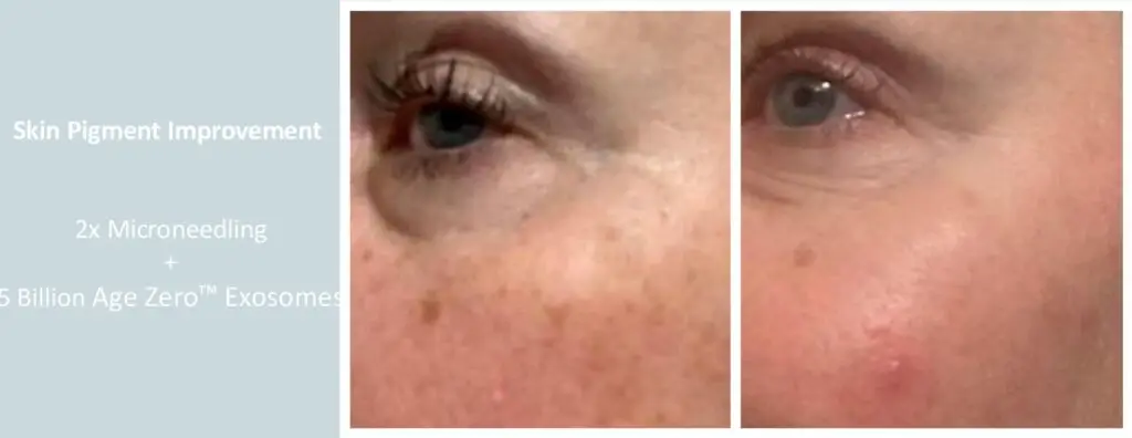 Age-Zero Exosomes help to diminish age spots and rejuvenate the skin.