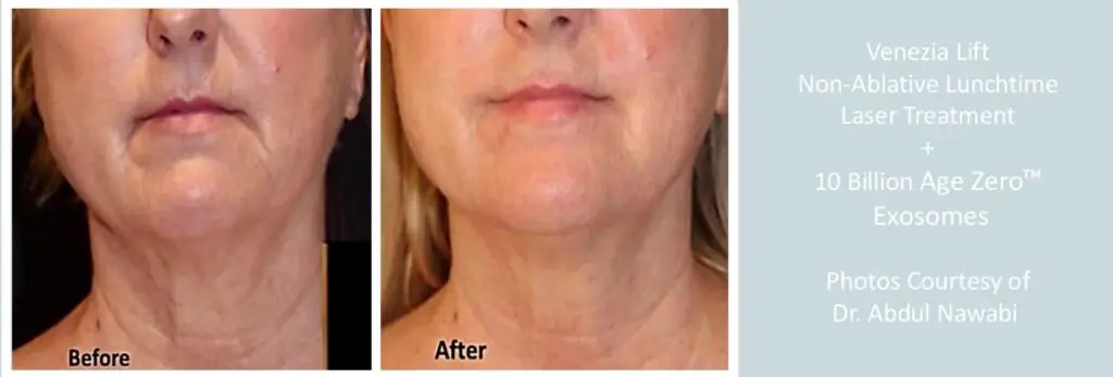 Age-Zero Exosome Skin Therapy at Aesthetic Studio in St. Augustine, Florida