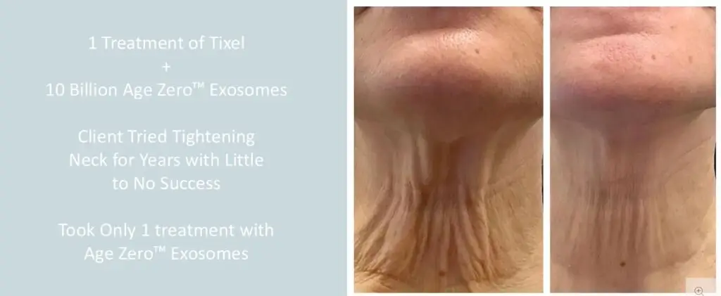 Age-Zero Exosome Skin Therapy at Aesthetic Studio in St. Augustine, Florida