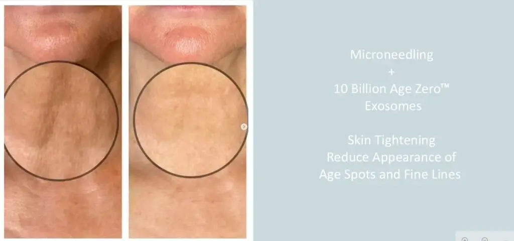 Age-Zero Exosome Skin Therapy at Aesthetic Studio in St. Augustine, Florida